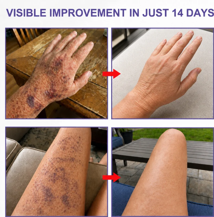 🔥Newly Upgraded🔥Skin-Strengthening Bruise Cream